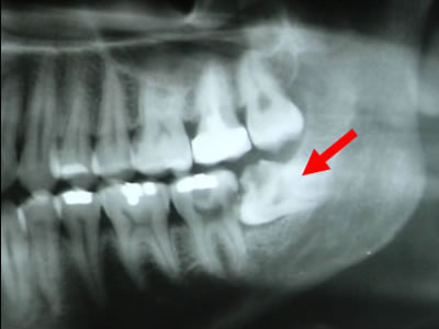 Отеки и флюсы после удаления молочного зуба