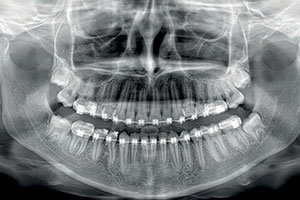 Панорамный снимок зубов - для чего он нужен при лечении и диагностики