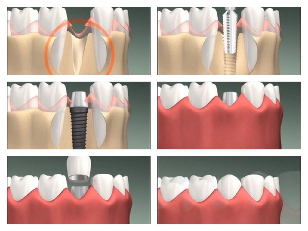 Имплантология в стоматологии, что такое зубной имплант - Новостом